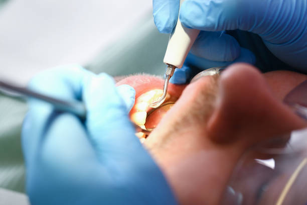 Best Emergency Wisdom Teeth Removal in Upland, IN